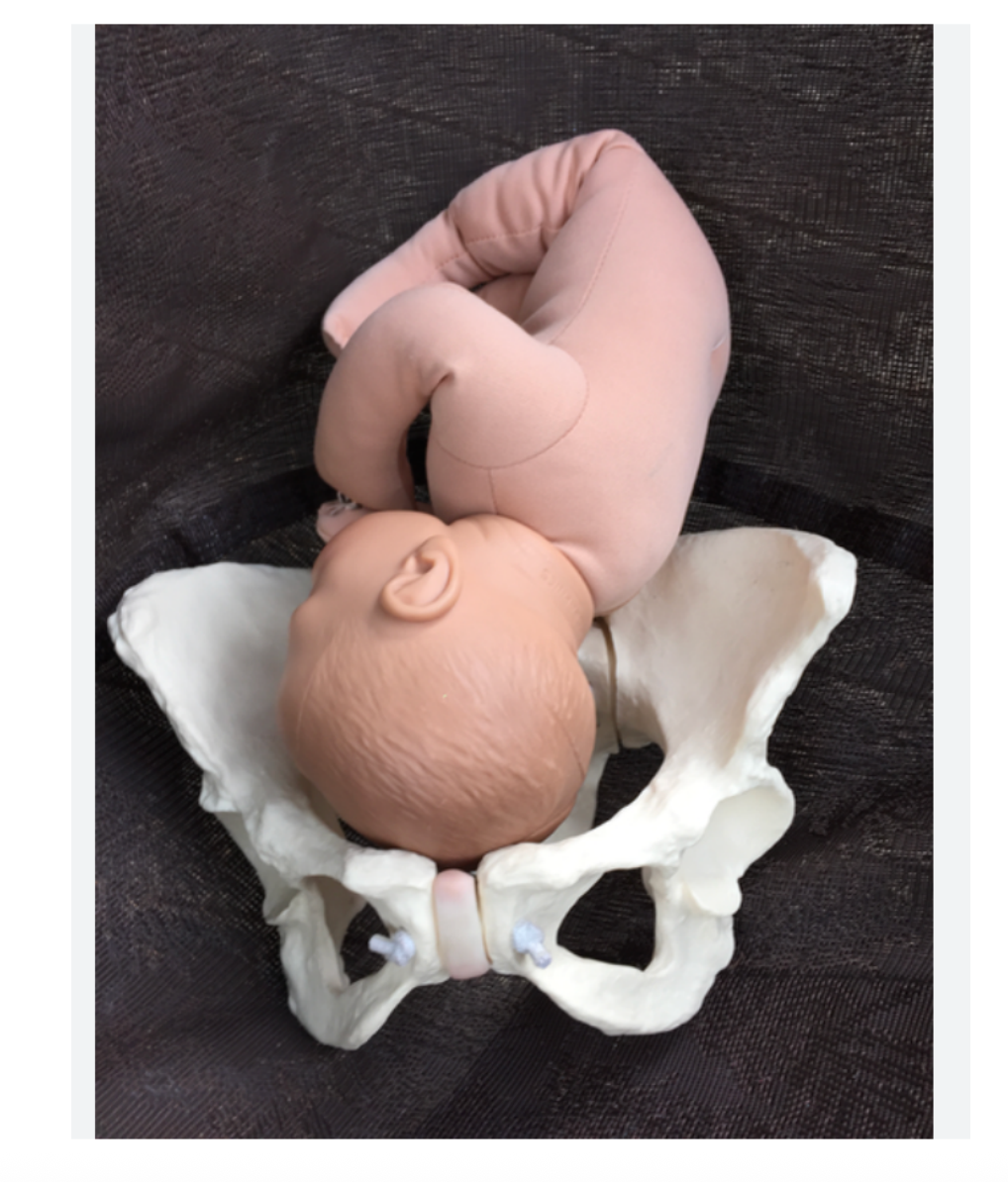 Baş Pelvis Uygunsuzluğu (Çatı Darlığı)